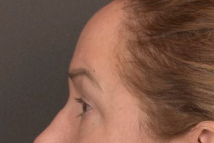 Brow Lift Before & After Patient #3917