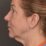 Facial Fat Grafting Before & After Patient #3918