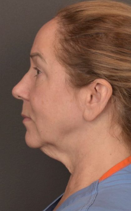 Facelift Before & After Patient #3914