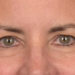 Blepharoplasty Before & After Patient #3963