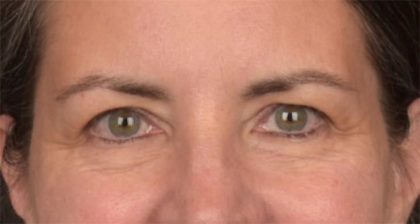 Blepharoplasty Before & After Patient #3963