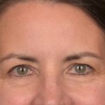 Brow Lift Before & After Patient #3964