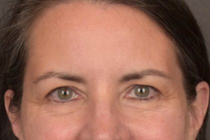 Brow Lift Before & After Patient #3964