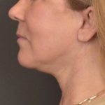 Neck Lift Before & After Patient #3915