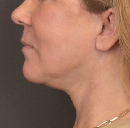 Neck Lift Before & After Patient #3915