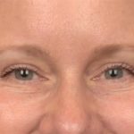 Blepharoplasty Before & After Patient #4016