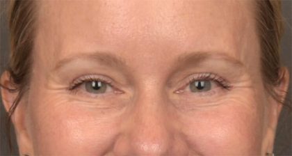 Blepharoplasty Before & After Patient #4016