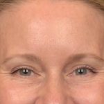 Brow Lift Before & After Patient #4017