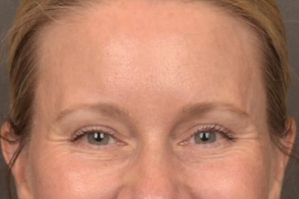 Brow Lift Before & After Patient #4017