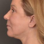 Facelift Before & After Patient #3914