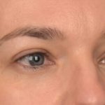 Blepharoplasty Before & After Patient #4059