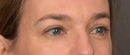Facial Fat Grafting Before & After Patient #4060
