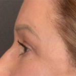 Blepharoplasty Before & After Patient #3916