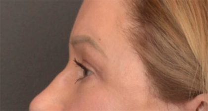 Blepharoplasty Before & After Patient #3916