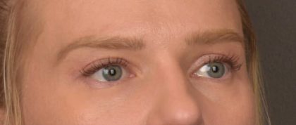 Brow Lift Before & After Patient #4075