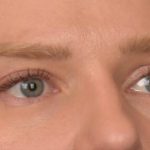Facial Fat Grafting Before & After Patient #4073