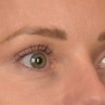 Blepharoplasty Before & After Patient #4094