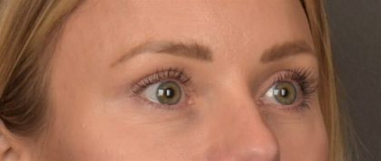 Facial Fat Grafting Before & After Patient #4096