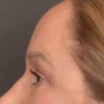 Brow Lift Before & After Patient #3917