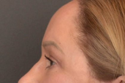 Brow Lift Before & After Patient #3917