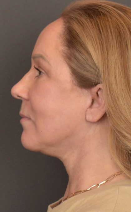 Facial Fat Grafting Before & After Patient #3918