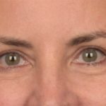 Blepharoplasty Before & After Patient #3963