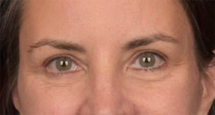 Blepharoplasty Before & After Patient #3963