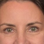 Brow Lift Before & After Patient #3964