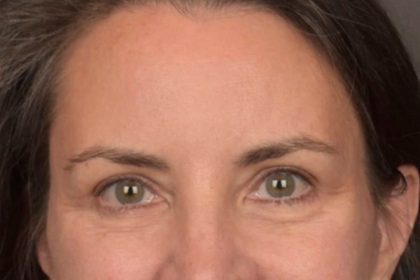 Brow Lift Before & After Patient #3964