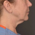Neck Lift Before & After Patient #3915