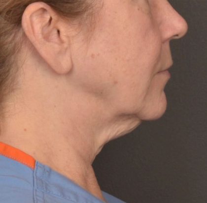 Neck Lift Before & After Patient #3915