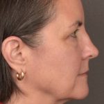 Facial Fat Grafting Before & After Patient #3965