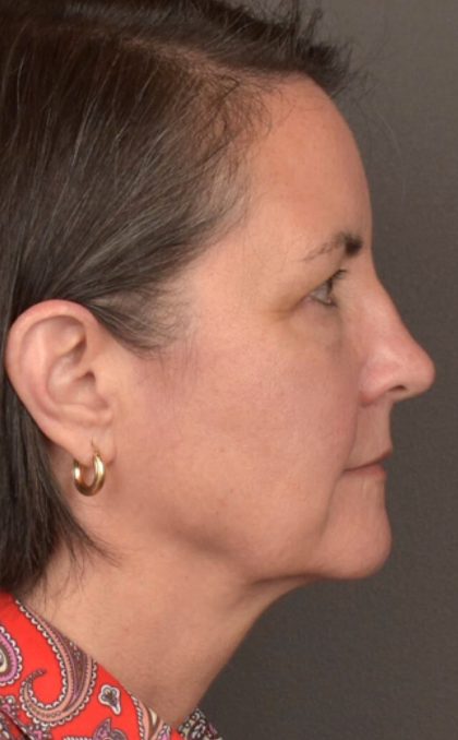 Facial Fat Grafting Before & After Patient #3965