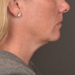 Neck Lift Before & After Patient #4015