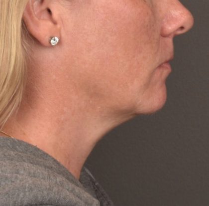 Neck Lift Before & After Patient #4015
