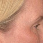 Blepharoplasty Before & After Patient #4016