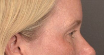 Blepharoplasty Before & After Patient #4016