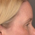 Brow Lift Before & After Patient #4017
