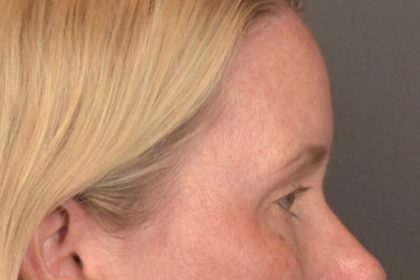 Brow Lift Before & After Patient #4017