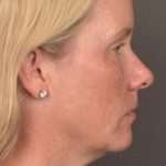 Facial Fat Grafting Before & After Patient #4018