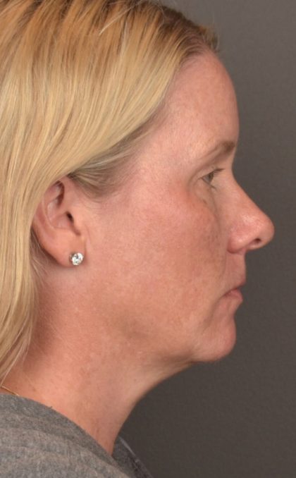 Facial Fat Grafting Before & After Patient #4018