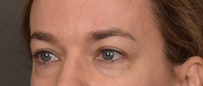 Blepharoplasty Before & After Patient #4059