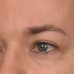 Facial Fat Grafting Before & After Patient #4060