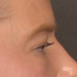 Blepharoplasty Before & After Patient #4074