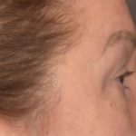Blepharoplasty Before & After Patient #3916