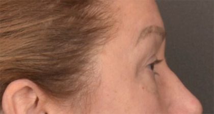 Blepharoplasty Before & After Patient #3916