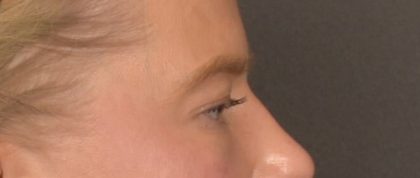 Facial Fat Grafting Before & After Patient #4073