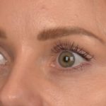 Blepharoplasty Before & After Patient #4094