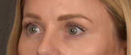 Brow Lift Before & After Patient #4095