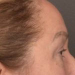 Brow Lift Before & After Patient #3917
